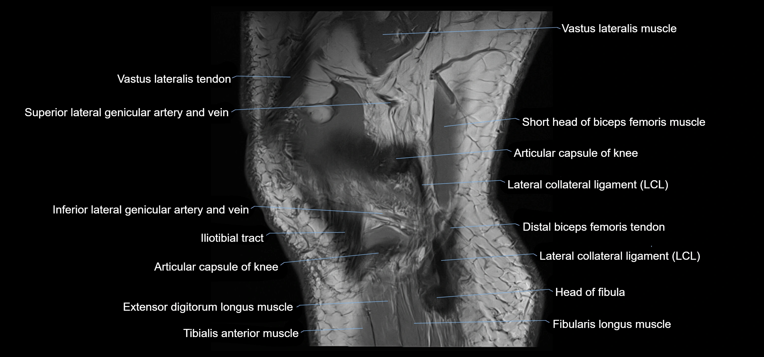 MRI knee sagittal cross sectional anatomy labelled 3T radiology image-00042.webp